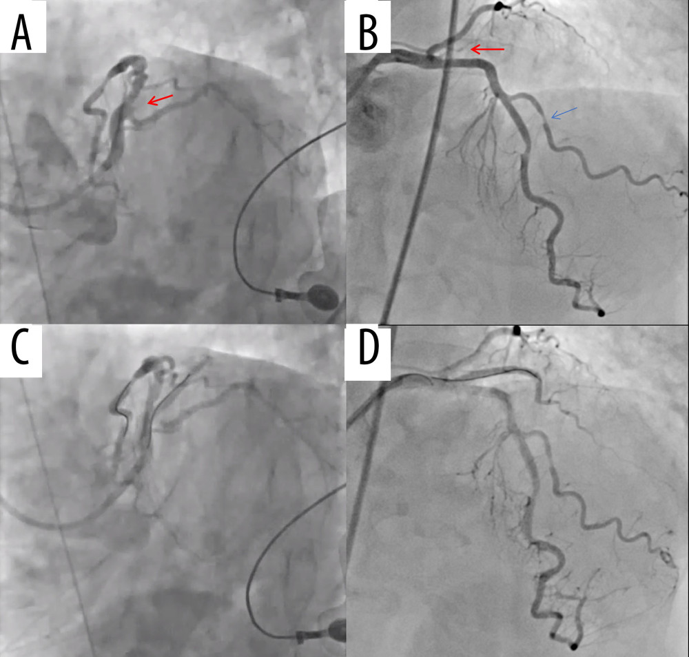 Emergency coronary angiography. (A, C) Left anterior oblique caudal view; (B, D) straight cranial view. (A, B) Pre-intervention images show an occluded first obtuse marginal branch of the left circumflex artery (red arrow) and 75% stenosis of the first diagonal branch (blue arrow). (C, D) Post-intervention images show that a drug-eluting stent was successfully deployed to the obtuse marginal branch artery, and the final angiogram demonstrated optimal results.