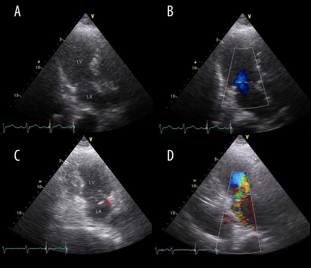 Serial Transthoracic echocardiography (TTE). (A, B) TTE 1 h after the catheterization shows mild mitral regurgitation. (C) TTE 4 days after the admission shows the head portion of the anterolateral papillary muscle swinging into the left atrium during systole (arrow). (D) TTE 4 days after the admission shows severe mitral regurgitation with a posterior jet caused by frail anterior mitral valve leaflet. LA – left atrium; LV – left ventricle; TTE – transthoracic echocardiography.