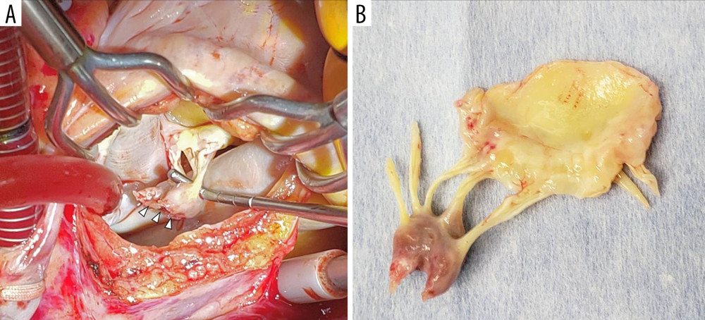 Intraoperative view. (A) Note the forceps grabbing the detached papillary muscle head (arrowheads). (B) The resected anterior mitral leaflet with part of the anterolateral papillary muscle. The mitral valve leaflets and chordae are left intact, except for the rupture surface.