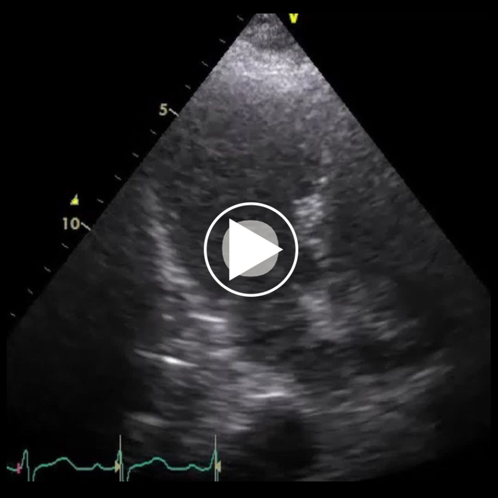 Transthoracic echocardiography on day 1 showing hypercontraction of the left ventricle.