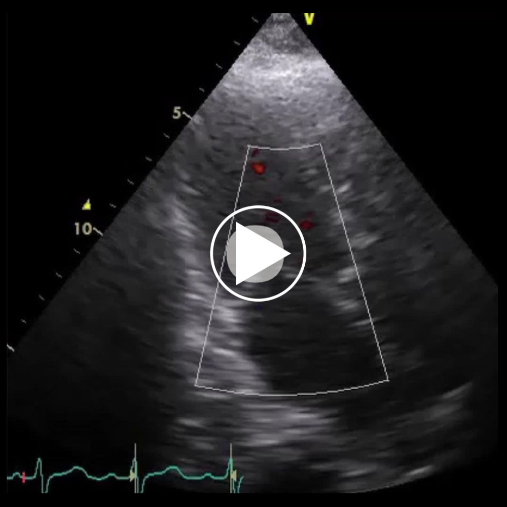 Color Doppler echocardiography on day 1 showing hypercontraction of the left ventricle with mild mitral regurgitation.