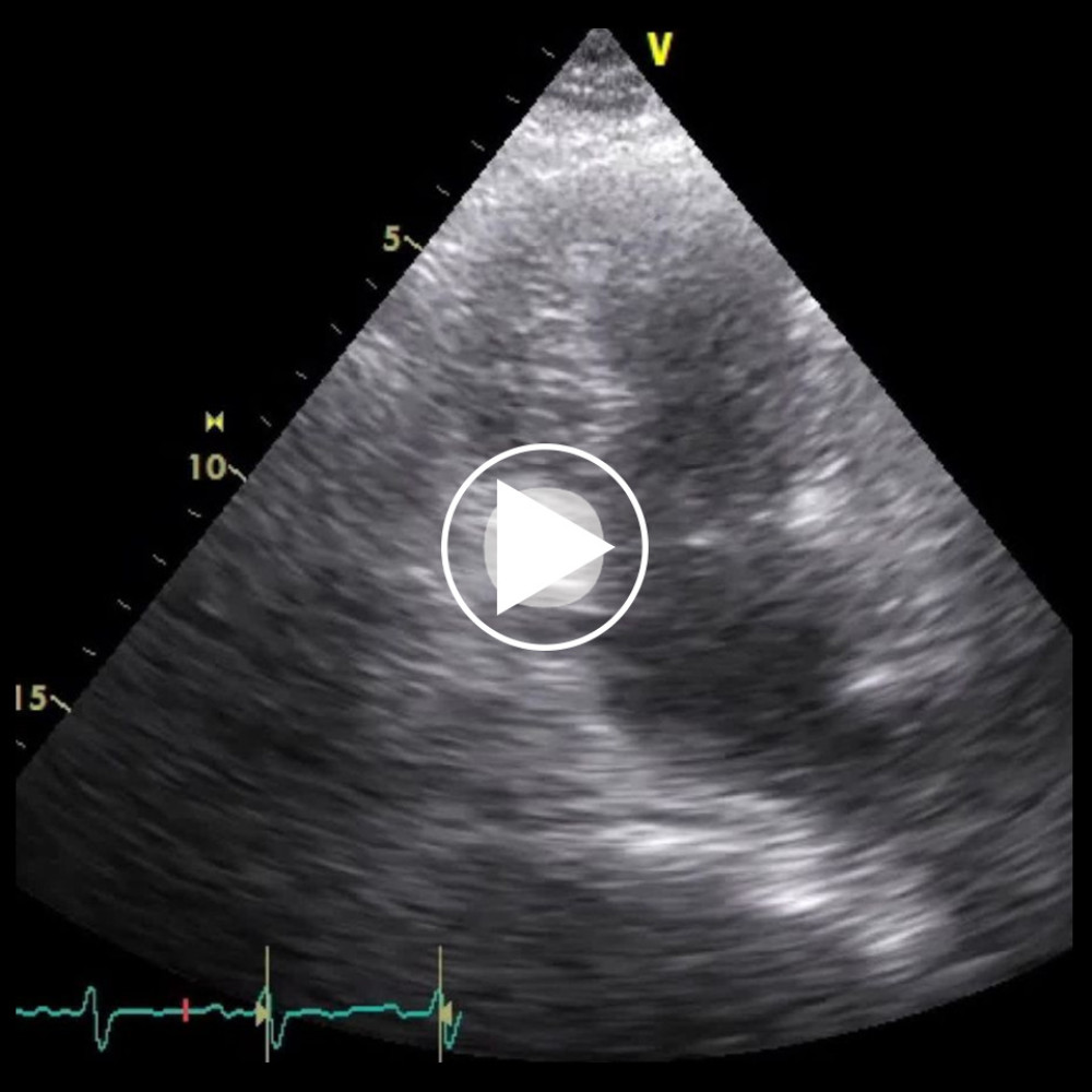 Transthoracic echocardiography on day 4 showing a ruptured papillary muscle prolapsing into the left atrium during systole and into the left ventricle during diastole.