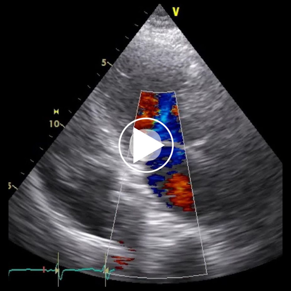 Color Doppler echocardiography on day 4 showing massive mitral regurgitation due to a flailing anterior mitral valve leaflet concurrent with hypercontraction of the left ventricle.