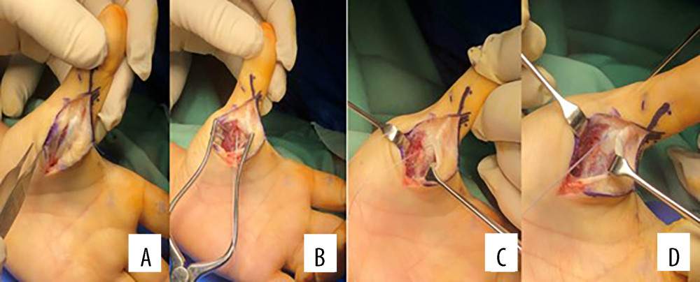 Intraoperative images showing (A) longitudinal incision along the palmar surface of the metacarpophalangeal joint of the thumb, (B) a bone anchor is inserted to the metacarpal head, (C) sutured volar plate and (D) immobilization of the metacarpophalangeal joint in 20° flexion using a Kirschner wire.