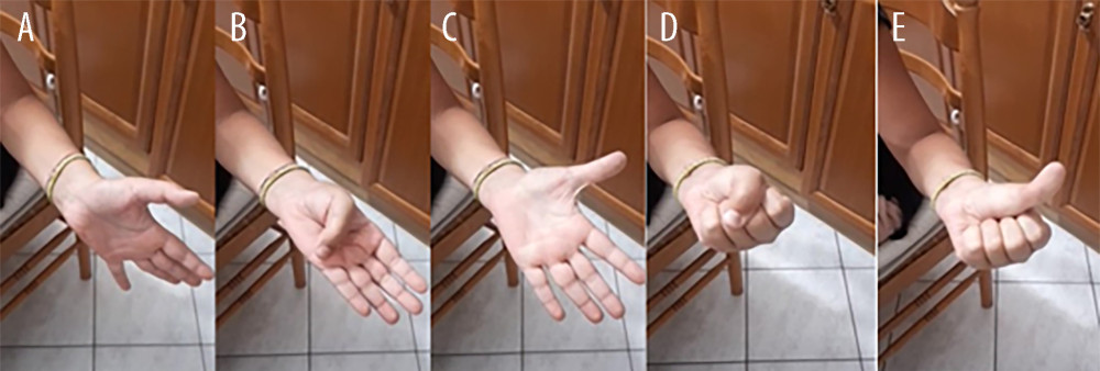 Photos showing (A) neutral position of the thumb, (B) flexion of the thumb, (C) extension and abduction of the thumb, (D) strong grasp power, and (E) extension of the thumb and flexion of other fingers.