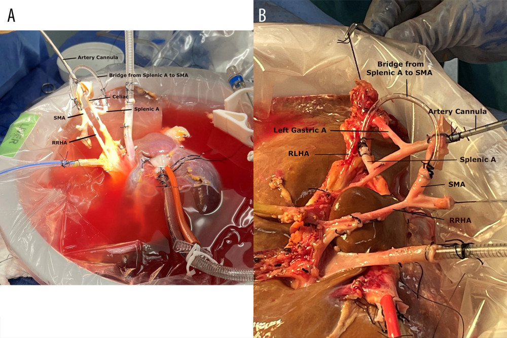 Donor liver at the back-table preparation. (A) Liver with replaced right hepatic artery (RRHA); (B) Liver with RRHA and replaced left hepatic artery (RLHA). A piece of intravenous-tube as a bridge from splenic artery (splenic A) to superior mesenteric artery (SMA) creates a single arterial cannulation for normothermic machine perfusion.