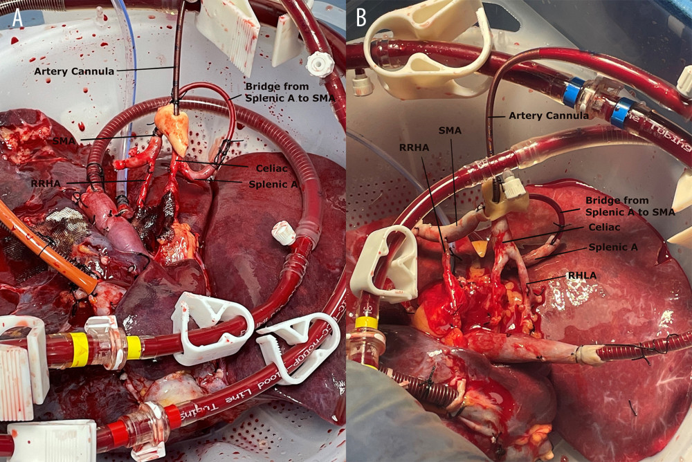 Donor livers on the normothermic machine perfusion. (A) liver with replaced right hepatic artery (RRHA); (B) liver with RRHA and replaced left hepatic artery (RLHA). The bridge from the splenic artery (splenic A) to the superior mesenteric artery (SMA) creates a single arterial cannulation and maintains an intact hepatic arterial vascular inflow for the liver grafts.