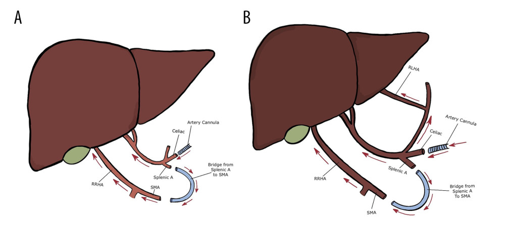Schematics of donor livers. (A) liver with replaced right hepatic artery (RRHA); (B) liver with RRHA and replaced left hepatic artery (RLHA). A piece of intravenous tube as a bridge from splenic artery (splenic A) to superior mesenteric artery (SMA) creates a single arterial cannulation for normothermic machine perfusion. Arrow points are the direction of arterial blood flow.