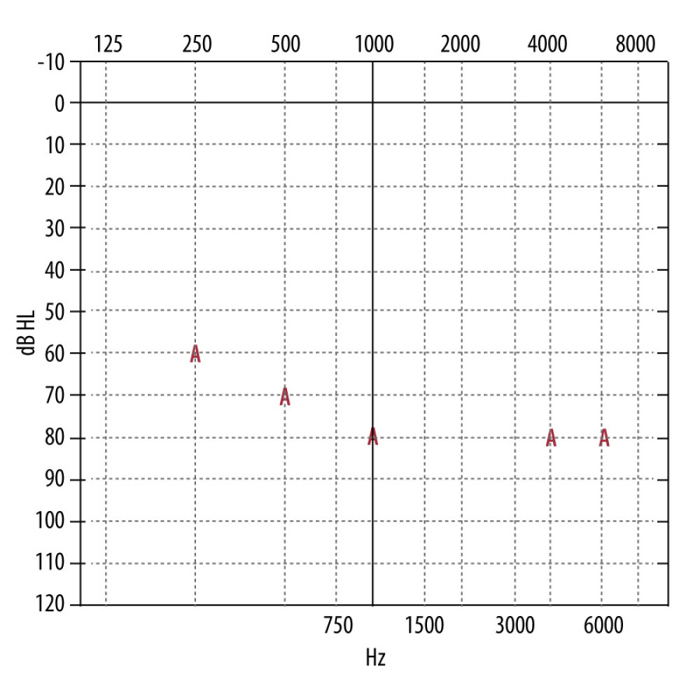 Free-field thresholds determined by behavioral observation audiometry (BOA) some 5 months after cochlear implantation in the right ear. Cochlear implant in right ear, left ear is open. Ratio of frequency (horizontal axis) to sound intensity (vertical axis). Own elaboration. dB HL – decibels hearing level; Hz – Herz; A – threshold.