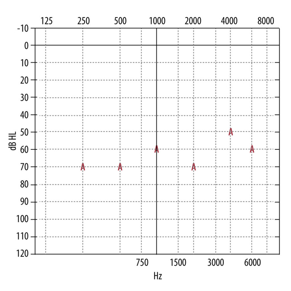 Free-field thresholds determined by behavioral observation audiometry (BOA) and visual reinforcement audiometry (VRA) 4 months after cochlear implantation in the left ear. Right ear is open, left ear with cochlear implant. Ratio of frequency (horizontal axis) to sound intensity (vertical axis). Own elaboration. dB HL – decibels hearing level; Hz – Herz; A – threshold.