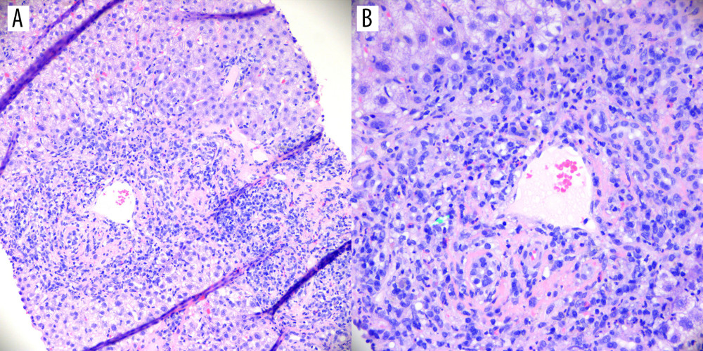 (A, B) Hepatic parenchyma on H&E-stained section at 200× and 400× magnifications, displaying prominent interface hepatitis with a distinct population of plasma cells consistent with autoimmune hepatitis.