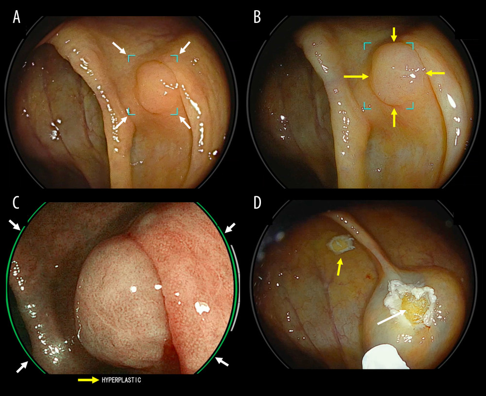 (A) Flat lesion located in the ascending colon, detected by artificial intelligence through green markings around the lesion on the display (white arrows). (B) Flat lesion (yellow arrows) visualized by chromoendoscopy - Linked Color Imaging (LCI). (C) Magnification and chromoendoscopy – Blue Light Imaging (BLI) – showing open crypts, suggesting a sessile serrated lesion. Artificial intelligence recognizes the lesion and characterizes it as hyperplastic through a green mark on the display (white arrows), and also creates text on the bottom line of the screen, just below the image (yellow arrow). (D) Immediately after the conventional mucosectomy, there was exposure of adipose tissue (white arrow) after resection and displacement of the lesion (yellow arrow), compatible with submucosal lipoma.