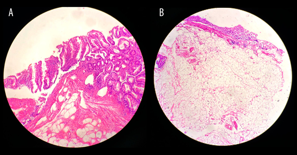 (A) Histologic imaging shows a sessile serrated lesion. (B) Histology demonstrates the presence of an adipose tissue into the submucosa, underneath the resected serrated lesion.