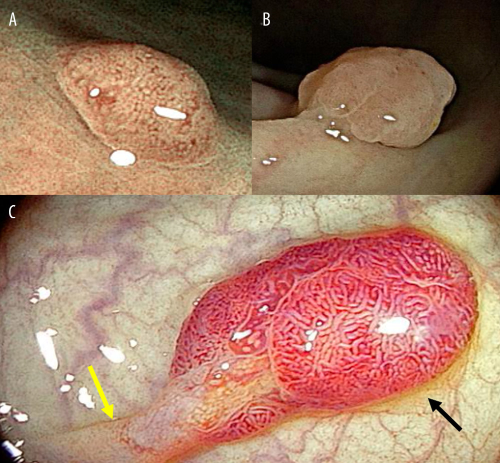 There were 3 polyps in the colon. (A) Sessile polyp in the transverse colon, measuring about 8 mm in size. (B) Sessile polyp in the descending colon, measuring approximately 5 mm in size. (C) Polyp with a long stalk (yellow arrow) and reddish cephalic portion (black arrow), with elongated crypts, located in the sigmoid colon.