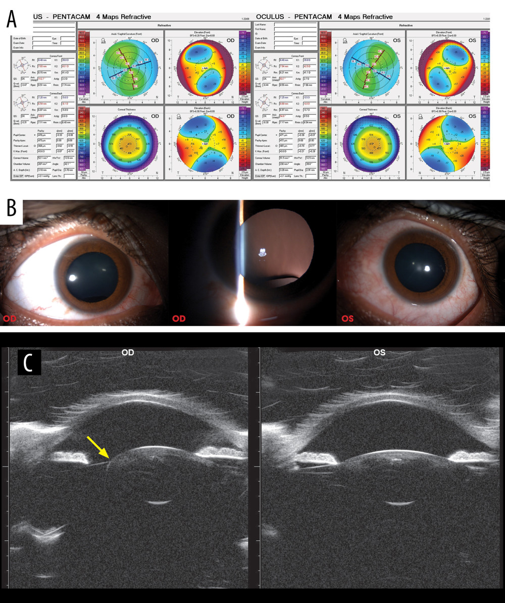 Preoperative assessment (A) Pentacam (Oculus Gmbh, Wetzlar, Germany) tomography of both eyes showing central corneal thickness of 473 µm in right eye and 472 µm in left eye; internal anterior chamber depth of 3.10 mm and 3.28 mm (B) slit lamp examination of the crystalline lens in both eyes, showing notching of the lens in the right eye (C) A high-resolution ultrasound biomicroscopy (50–100 MHz transducer-probe) illustrating the lenticular coloboma at 6 o’clock position in the right eye.
