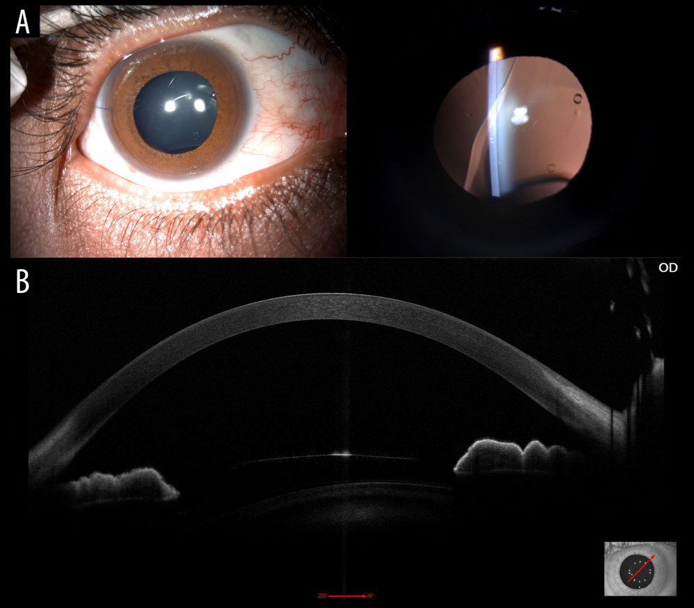(A) Implantable collamer lens (ICL) subluxation and rotation on slit lamp examination of the right eye with a dilated pupil. (B) Anterior segment ocular coherence tomography (MS-39; Costruzione Strumenti Oftalmici, Italy) showing ICL subluxation and low central vault (distance between ICL and crystalline lens).