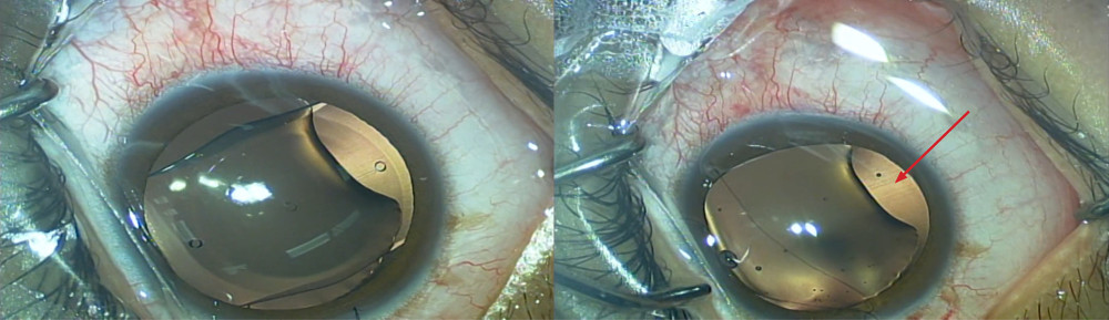 Intraoperative image of the extent of the lenticular coloboma and partial lens density of zonules (red arrow) after obtaining maximal pupil dilation with an intracameral mydriatic.