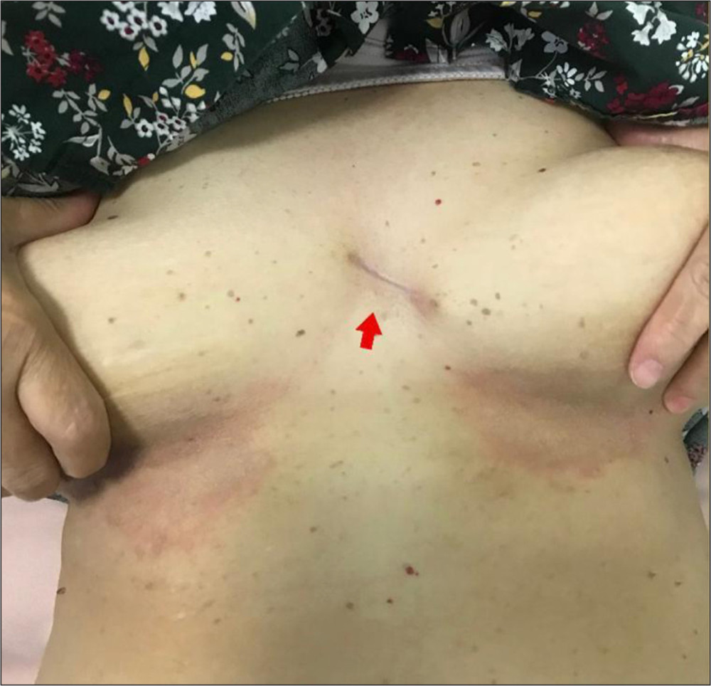 The original position of the bony lesion and well-healed scar of post-surgical excisional biopsy in the middle of the sternum. The patient also had a fungal infection under the breasts, which was treated successfully. Arrow indicates the lesion.