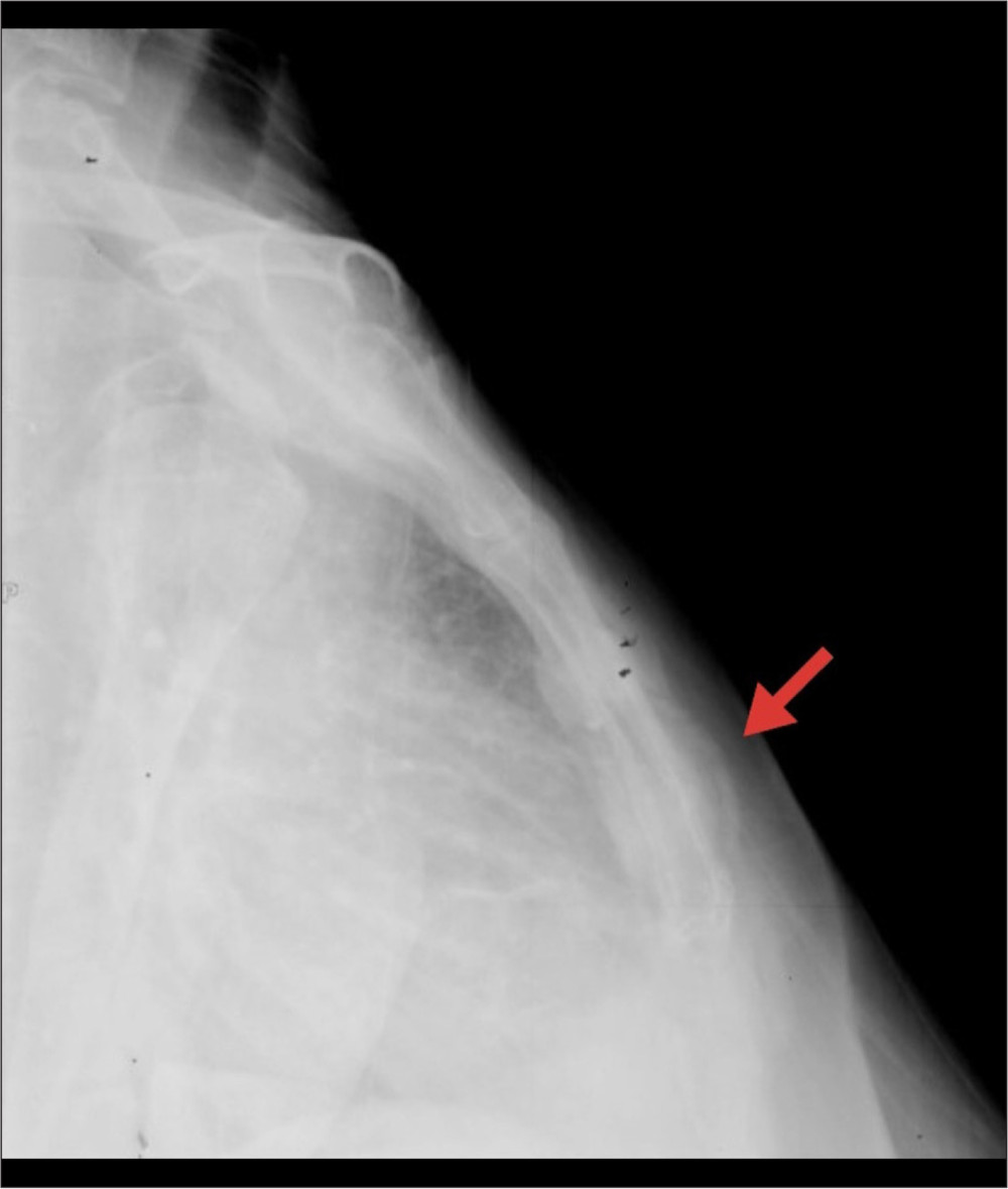 Lateral X-ray of the sternum. Arrow indicates the lesion.