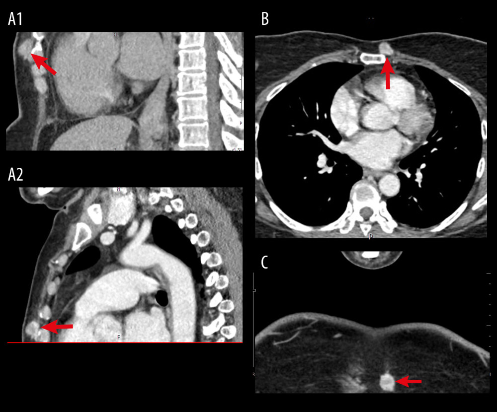 Computed tomography (CT) scan findings of the sternal mass. (A1, A2) sagittal views (B) axial view (C) coronal view. Arrow indicates the lesion.