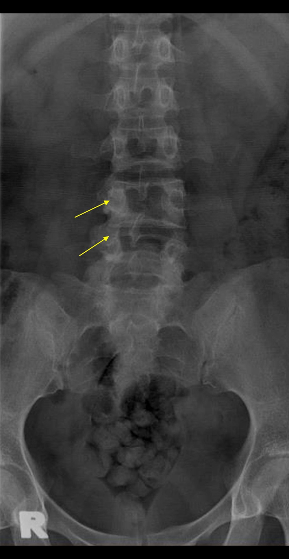 Anteroposterior view of the lumbosacral plain X-ray showing sclerosis and erosion of the right pedicle at the L4 and L5 levels (yellow arrows).
