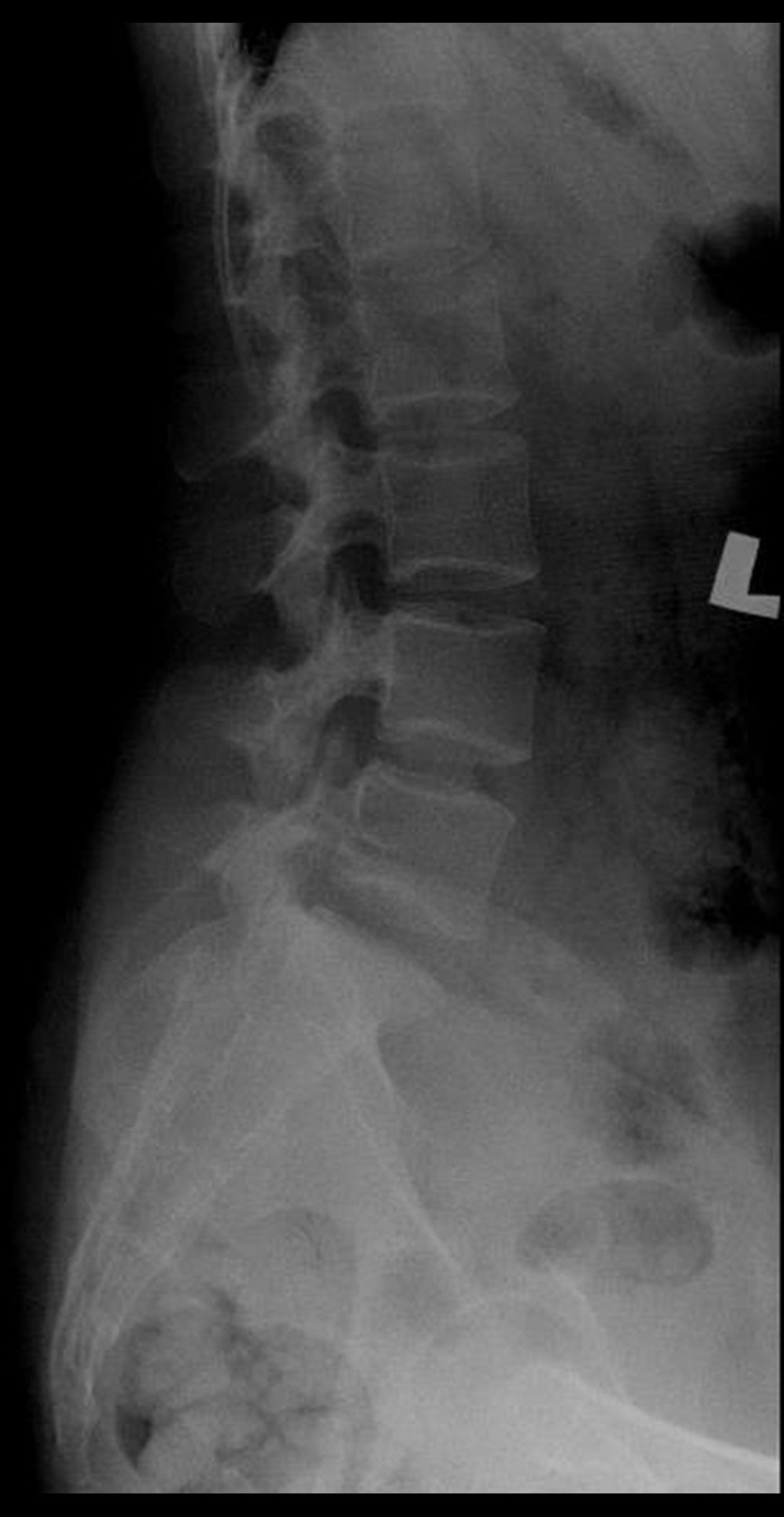 Lateral view of the lumbosacral plain X-ray.