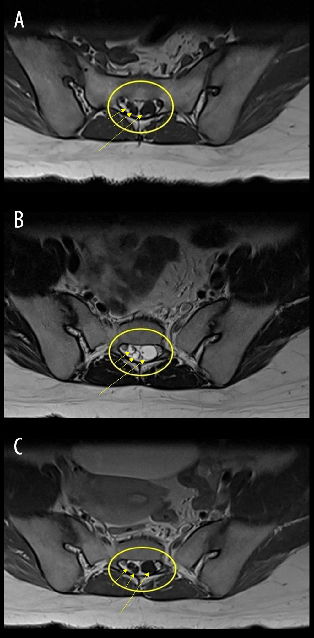 (A) Axial T1-weighted image at the S2 level, showing several perineural lesions (in yellow circle with arrows) in the spinal canal at the S2 vertebral level. These lesions demonstrate low signal on T1-weighted image. (B) Axial T2-weighted image at the S2 level showing hyperintense lesions (in yellow circle with arrows). (C) Axial post-gadolinium administration at the S2 level showing unenhanced lesions (in yellow circle with arrows) after the administration of gadolinium.