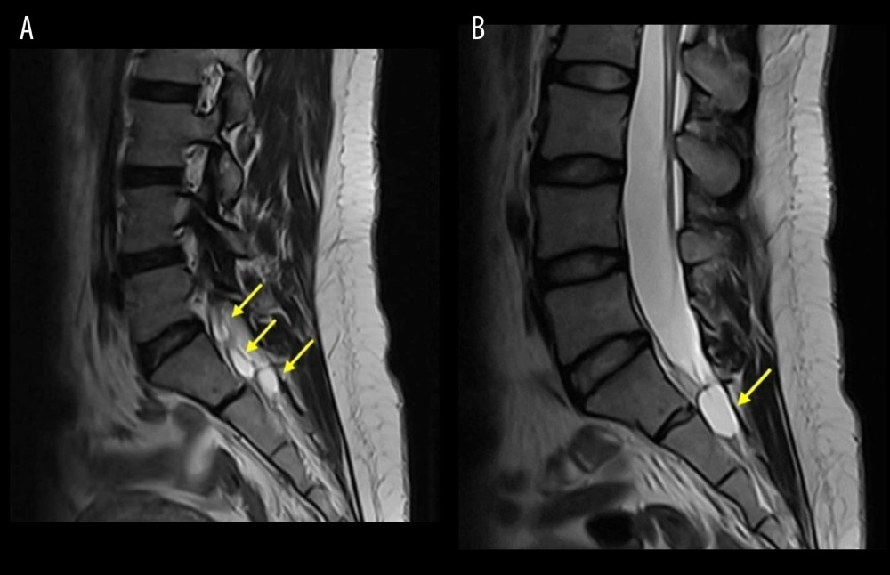 (A) Right parasagittal T2-weighted image showing the perineural lesions (yellow arrows). (B) Left parasagittal T2-weighted image showing the dominant cyst, measuring 1.5×1.3×2.0 cm (yellow arrow).