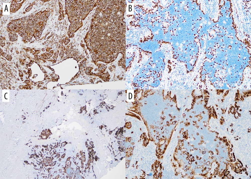 Immunohistochemical stains show thin-walled vessels lined by A: CD31 (+), and B: ERG (+) in endothelial cells, C: D2-40 highlights the lymphatic channels (2×), D: Positivity for podoplanin (D2-40) in the neoplastic cells (10×).