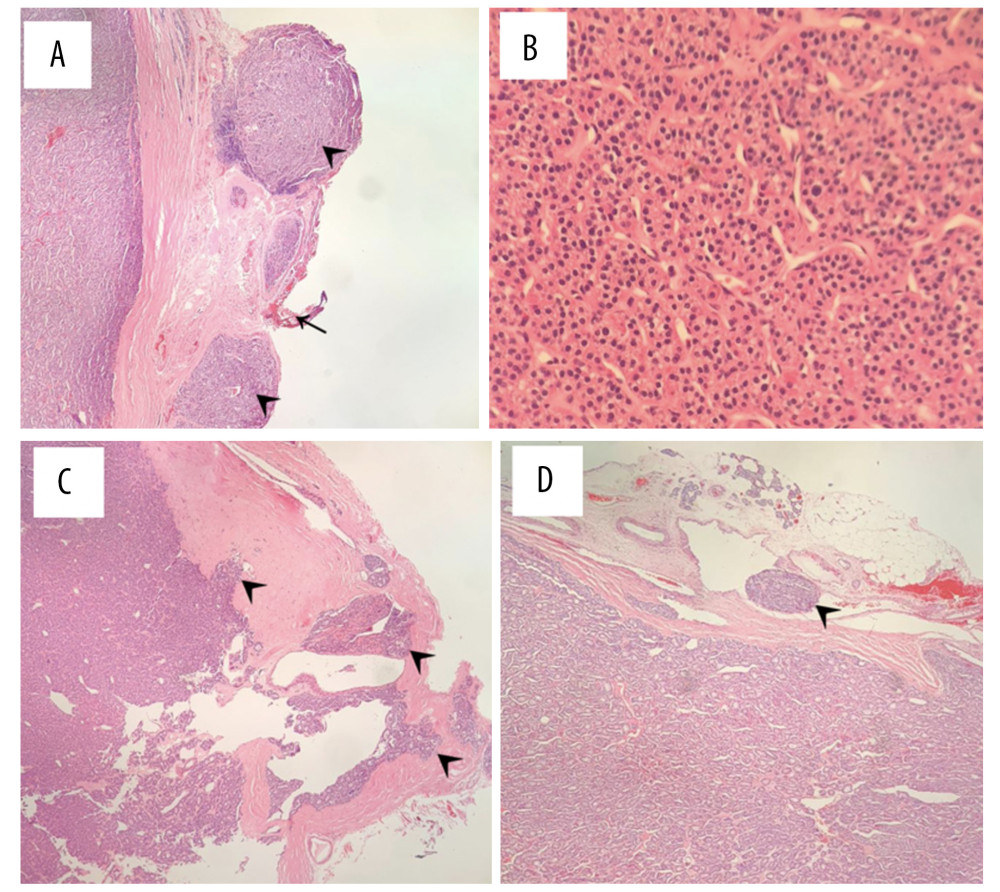 Final histopathological analysis of the first case. (A) Tumor nodules (arrowheads) directly against the cauterized margin (arrow) 40× magnification, Hematoxylin and eosin staining. (B) Proliferation of chief cells without evidence of atypia or mitotic activity 400× magnification, Hematoxylin and eosin staining. (C) Arrowheads demonstrate capsular invasion 40× magnification, Hematoxylin and eosin staining. (D) Arrowhead showing evidence of vascular invasion 40× magnification. Hematoxylin and eosin staining.