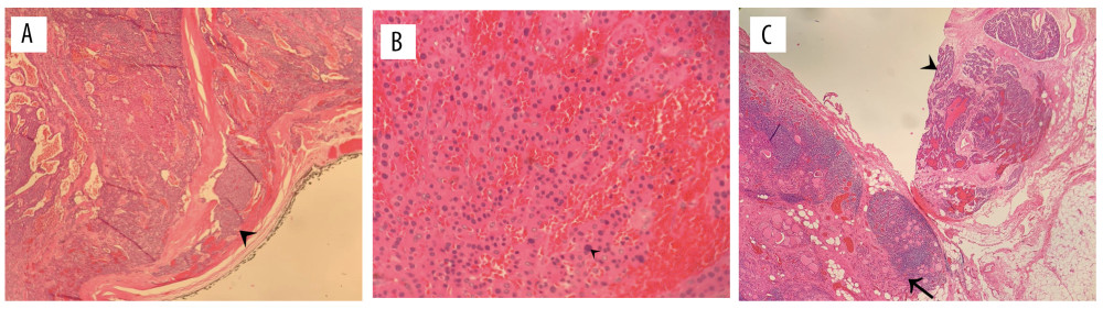 Final histopathological analysis of the second case. (A) Arrowhead demonstrates capsular invasion, with the ink showcasing the clear resection margin, 40× magnification Hematoxylin and eosin staining. (B) Oxyntic cells showing focal nuclear atypia (arrowhead), 400× magnification hematoxylin and eosin staining. (C) Parathyroid tissue on the right side (arrowhead) is adjacent to the thyroid tissue showing lymphocytic thyroiditis on the left (arrow) – which can be considered a sign of aggressiveness. 40× magnification. Hematoxylin and eosin staining.