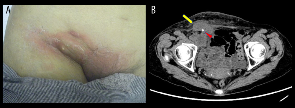 Findings of postoperative infection. (A) Swelling and redness of the right groin. (B) Computed tomography image. Fluid collection (arrow) in the right groin. Arrowhead: a tack, used in hernia repair.