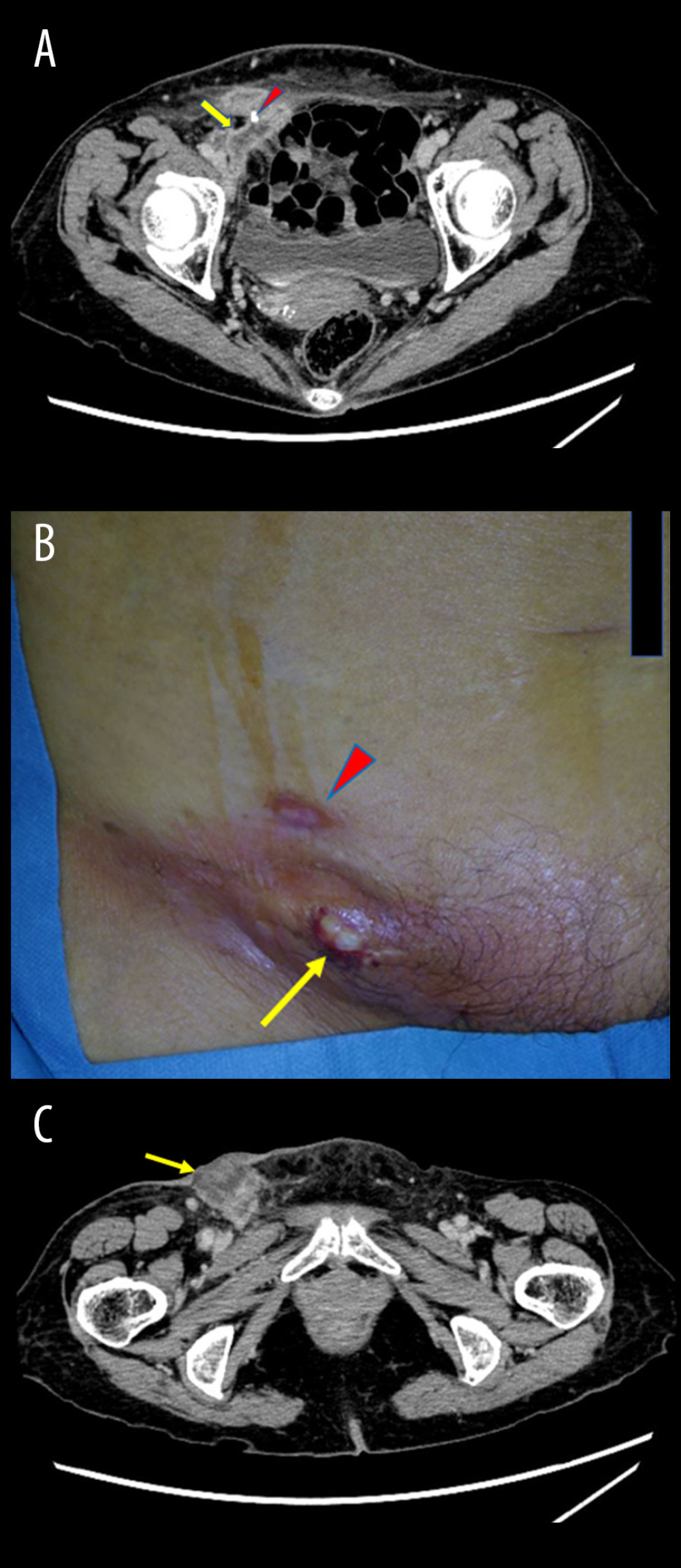 Findings on contrast-enhanced computed tomography and gross finding in the right groin. (A) Arrow: inflammation around a mesh, arrowhead: a tack. (B) Arrow: purulent discharge, arrowhead: first drainage site after conservative treatment. (C) Arrow: abscess below the right groin.