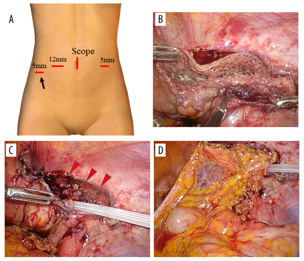 Port placement and intraoperative findings. (A) Port placement. Arrow: Clio drain insertion port. (B) Infected mesh removal. (C) Drain insertion to an infected peritoneal cavity. Arrowheads: peritoneal defect. (D) The omentum used to cover a peritoneal defect.
