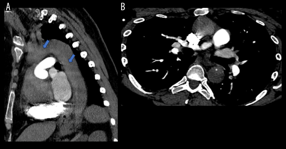 Chest computed tomography scan with contrast. (A) Sagittal chest computed tomography scan with contrast administration timed to evaluate the pulmonary arteries. No pulmonary embolic disease was detected. Higher density of blood along the aortic arch and descending aorta (arrows) was appreciated. The fetus was intentionally not imaged to minimize radiation exposure. (B) Axial chest computed tomography scan with contrast administration timed to evaluate the pulmonary arteries showing the true lumen of the descending aorta dissection (star).