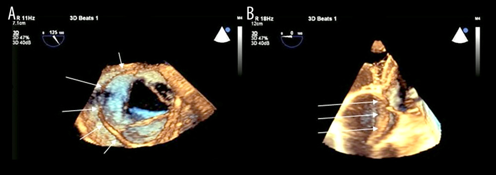 Three-dimensional transesophageal echocardiogram of the aortic valve. Short axis view (A) and modified 3-chamber view (B) demonstrating a dissection flap in close proximity to, and prolapsing across, the aortic valve (arrows).