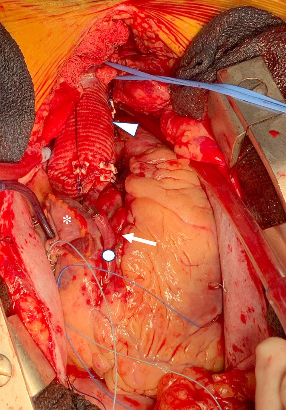 Post-bypass gross photograph of the heart and ascending aorta. The aortic root was reconstructed using a valve-sparing technique. The right atrium (star) was used for central venous cannulation and later secured with a blue tourniquet. The arterial cannula has been removed and hemostasis achieved using a pledgeted purse string suture on the lateral side of the aortic graft (triangle). The right coronary artery demonstrates periarterial hematoma (arrow) from the proximal dissection, which was bypassed with a vein graft (circle). A blue vessel loop is retracting the innominate vein to better expose the innominate artery, which was reimplanted.