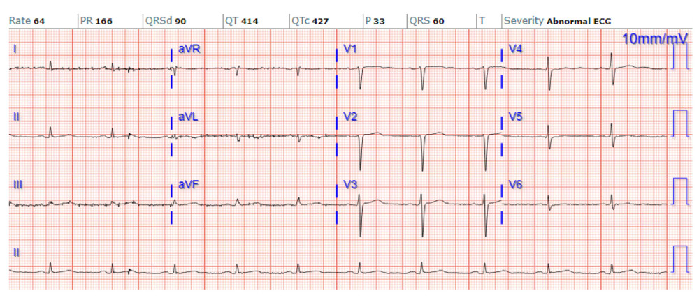 Electrocardiogram on admission. Normal sinus rhythm with low-voltage QRS.