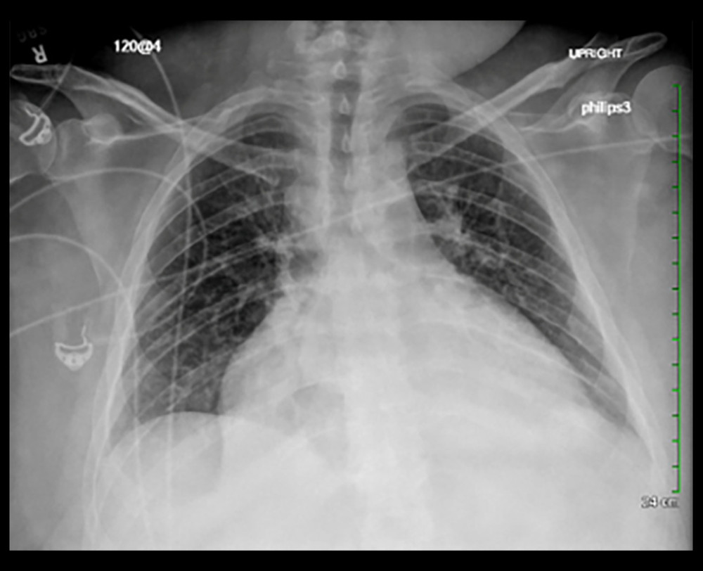 Portable chest radiography during admission. Radiography of the chest showing enlarged cardiac silhouette.