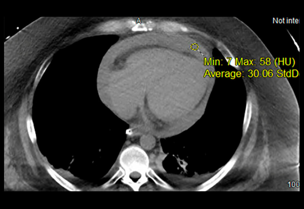 Computed tomography of the chest. Large pericardial effusion greater than simple fluid density approximately 30 Hounsfield units.