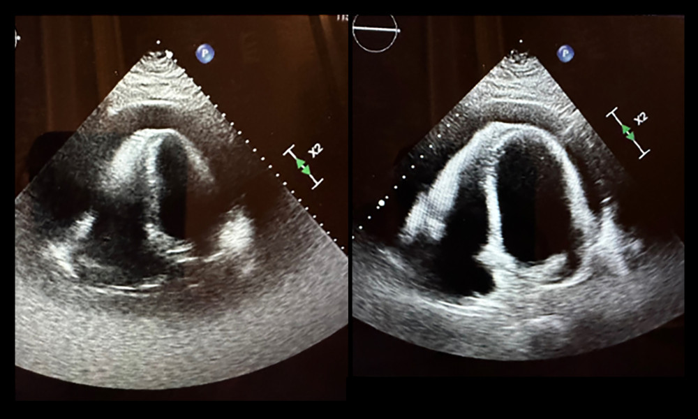 Transthoracic echocardiography after CT. Large circumferential pericardial effusion without RA/RV collapse.