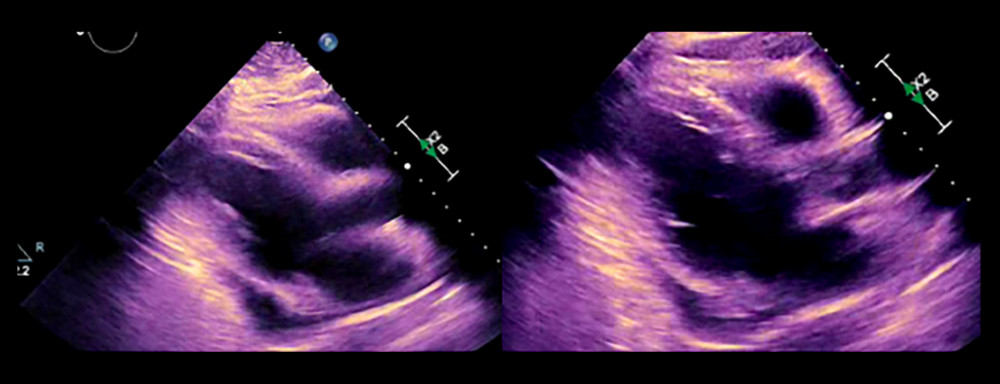 Transesophageal echocardiogram before discharge. TTE showing moderate pericardial effusion smaller in size than previous studies.