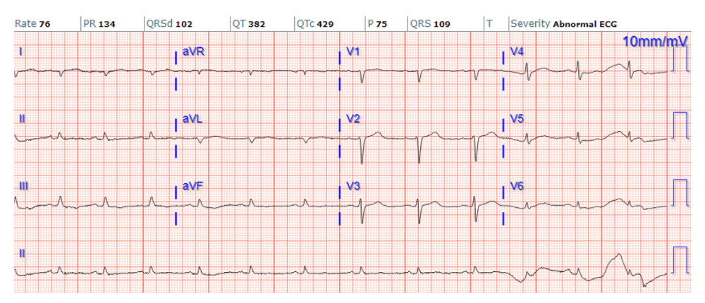 Electrocardiogram on discharge. Unchanged from admission. Normal sinus rhythm with low-voltage QRS.