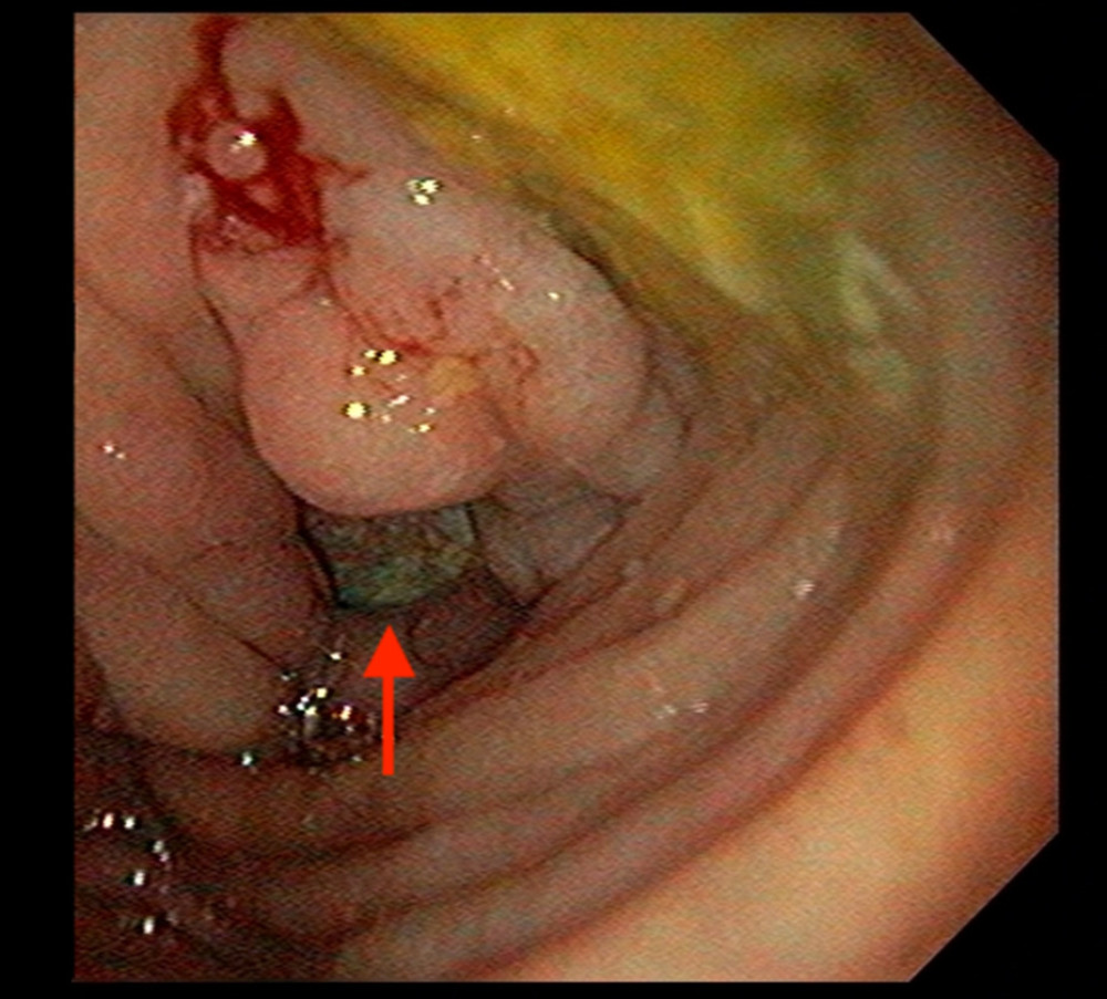 Upper digestive endoscopy demonstrating a suspected duodenal fistula.