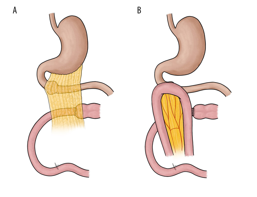 (A) Drawing demonstrating primary transverse closure followed by omental patching. (B) Drawing demonstrating duodenojejunostomy, which can be used for larger defects (larger than 3 cm).