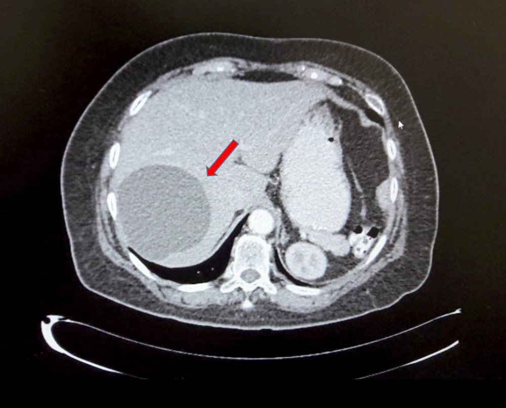 Presence of hydatid cyst at the level of the liver (red arrow) in the patient without biliary involvement, by means of computed tomography abdominal contrast with optiray, transverse plane. Focal lesions in the right hepatic lobe, hypodense, with a single septum and transverse diameter of 110 mm.