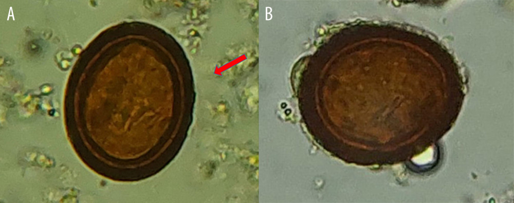 (A, B) Microscopic identification of Echinococcus granulosus eggs (red arrow) in domestic dog feces obtained by direct coproparasitic technique, observed by optical microscopy at 40× and stained with Lugol.
