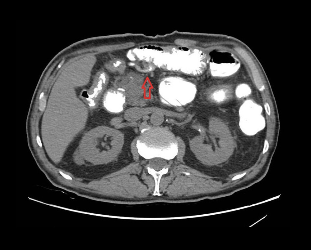 Abdominal CT scan with oral contrast showing passage of the contrast through the anastomoses, with no leakages, strictures, or free abdominal fluid or collection. The arrow points to a moderately distended small bowel and evident change of caliber in the area of the jejunojejunal anastomosis.