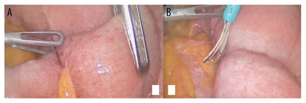 Intraoperative volvulus. (A) Intraoperative laparoscopic evidence of the strangling girdle. (B) long barbed suture tail before being divided and trimmed.