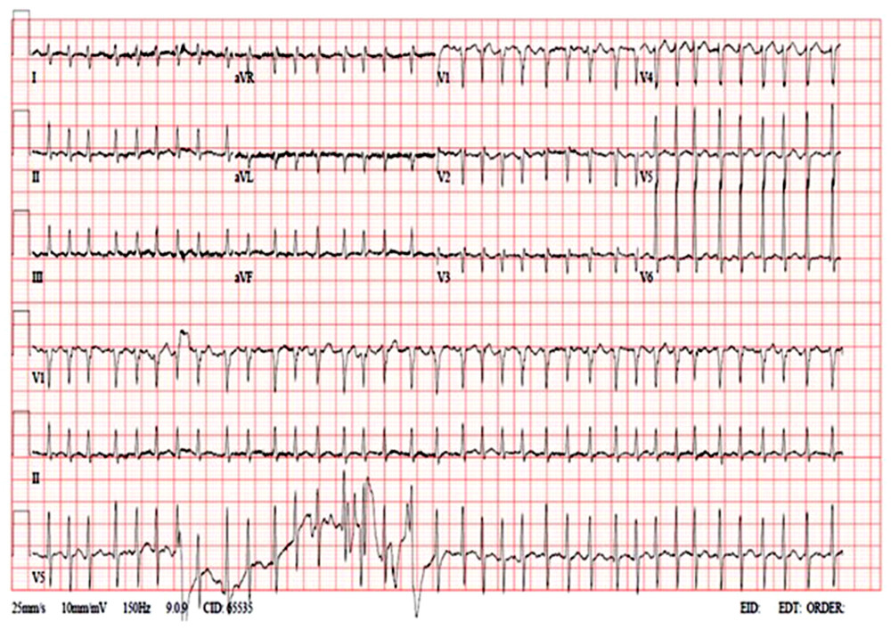 12-Lead ECG showing atrial fibrillation.